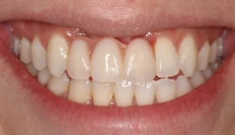 Temporary Denture During Healing of Jawbone
